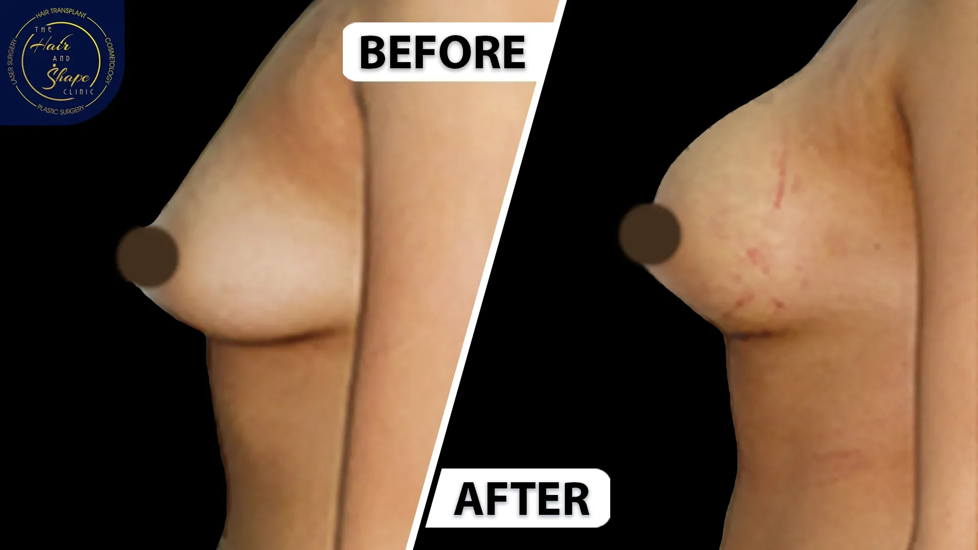 Breast Augmentation result6